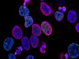 Pancreatic Cancer Awareness Low Among Under-50 Adults, Despite Rising Cases Pancreatic Cancer Awareness Low Among Under-50 Adults, Despite Rising Cases