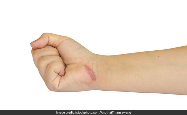 Top Natural Remedies For Keloids
