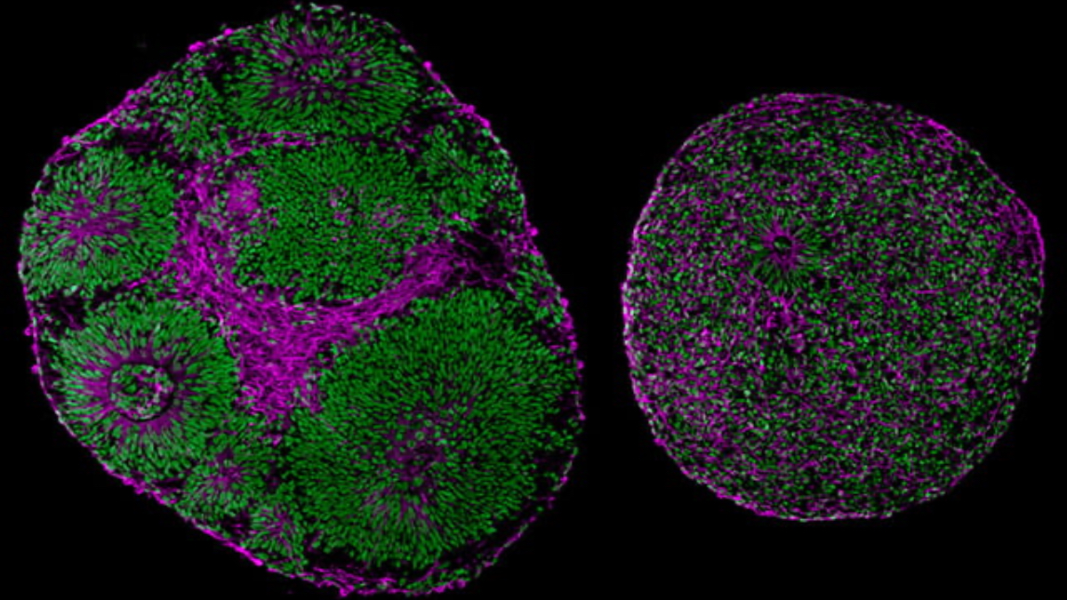 Autism-Linked Gene Mutation Reversed Using Lab-Grown Brain Experiment
