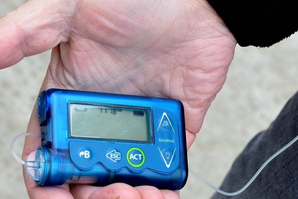 Healthcare Experts Give Nod to DIY Artificial Pancreas System for Managing Type 1 Diabetes