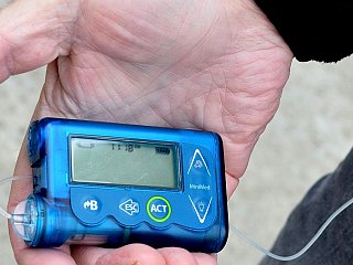 Healthcare Experts Give Nod to DIY Artificial Pancreas System for Managing Type 1 Diabetes