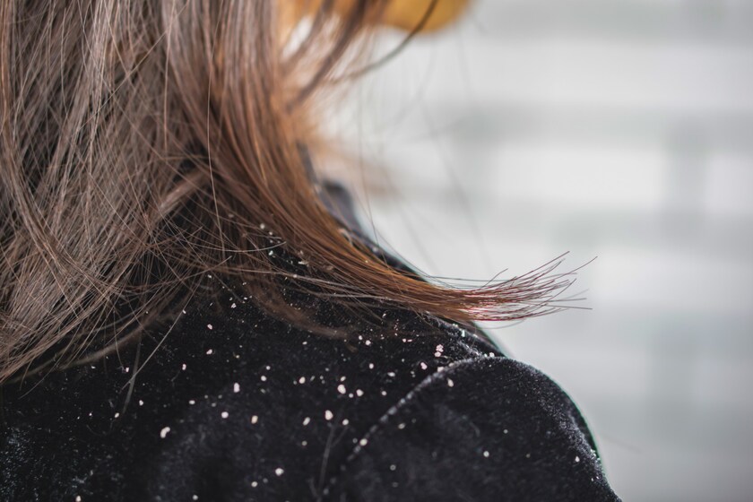 How To Get Rid Of Dandruff: Home Remedies To The Rescue