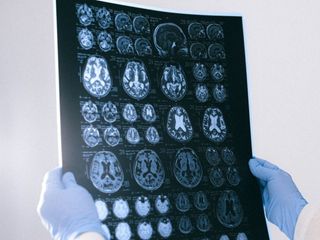 Drugs Used for Treating ADHD Could Help Treat Alzheimer&rsquo;s Symptoms