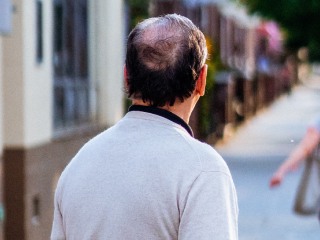 Suffering From Hair Loss or Baldness? New Study May Have Solution for You