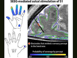 Minimally Invasive Electrode Brain Implant Can Restore Sense of Touch, Claim Researchers