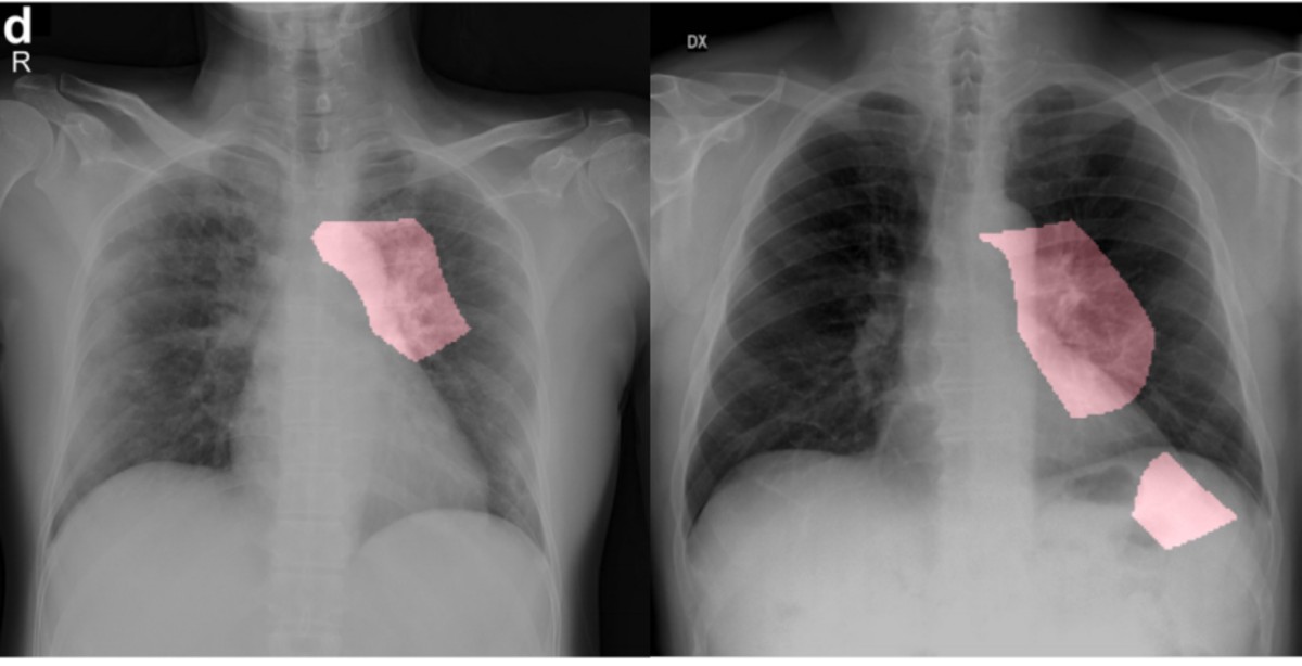 COVID-Net AI Tool Can Help in Identifying COVID-19 in Chest X-Rays