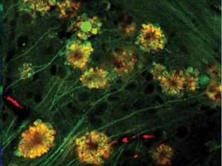 Neural &lsquo;Poisonous Flowers&rsquo; Could Be the Primary Cause of Alzheimer&rsquo;s Disease, Says New Study