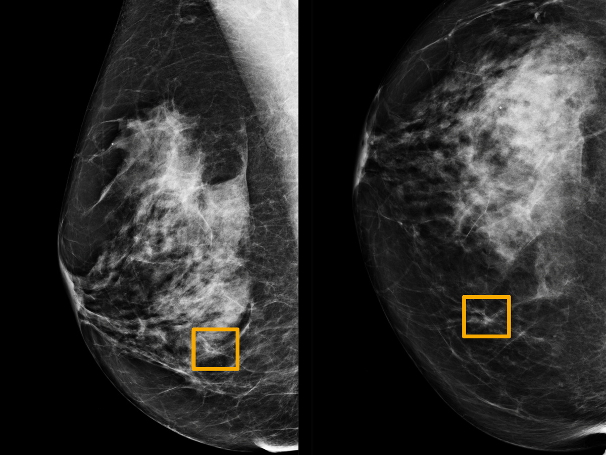 Google AI System Could Aid Breast Cancer Detection, Study Finds