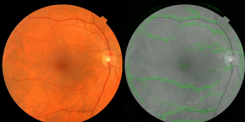 Google, Verily Life Sciences Use AI to Scan Eyes for Heart Risk
