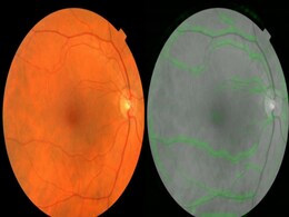 Google, Verily Life Sciences Use AI to Scan Eyes for Heart Risk Google, Verily Life Sciences Use AI to Scan Eyes for Heart Risk