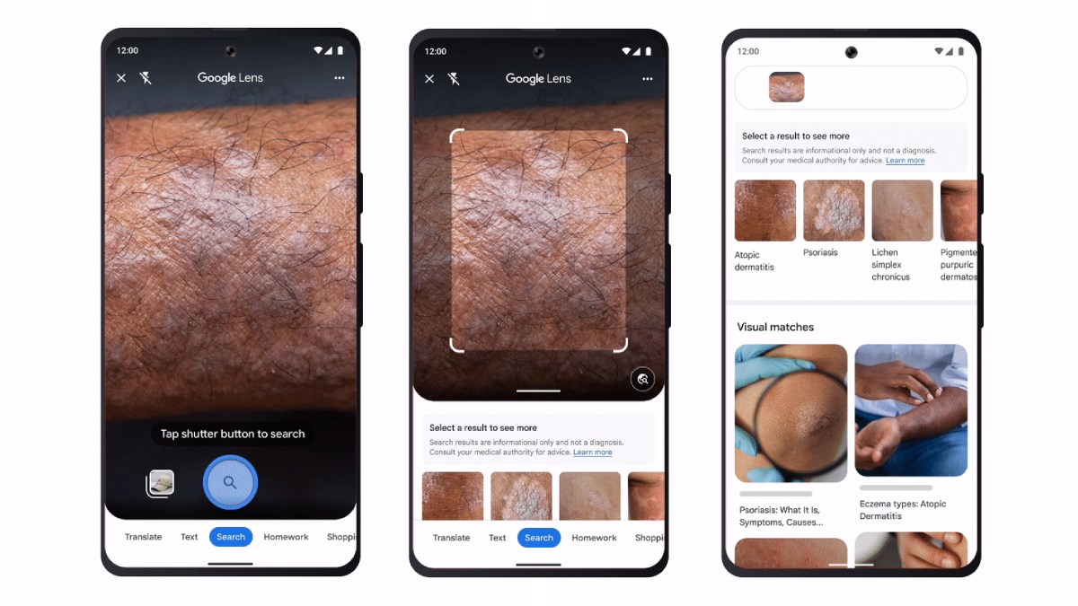 Google Lens Updated With Support for Skin Condition Detection; Google Bard Adds Lens Support
