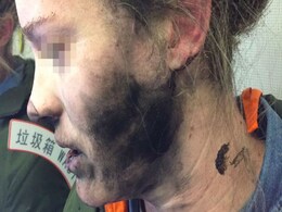 Woman Suffers Burns to Face, Hands When Her Headphones Explode Mid-Flight Woman Suffers Burns to Face, Hands When Her Headphones Explode Mid-Flight