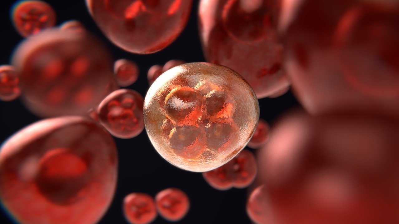 First Woman Said to Be Cured of HIV After Stem Cell Transplant