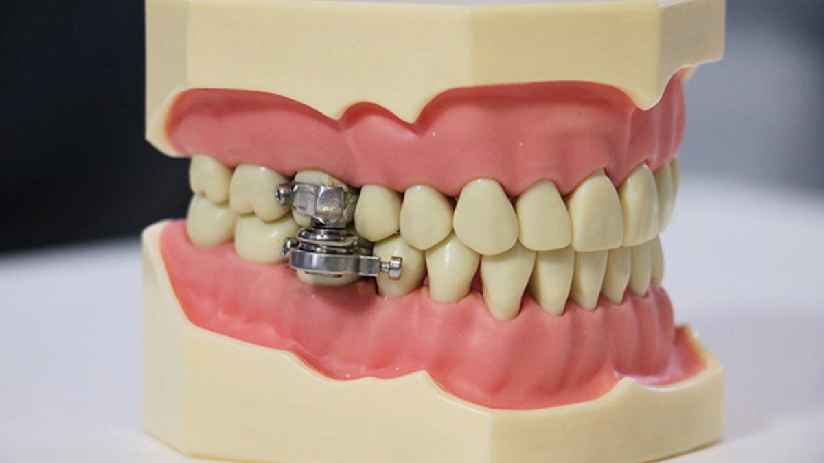 This Dental Device May Help Fight Obesity, But Twitter Users Find It Shocking