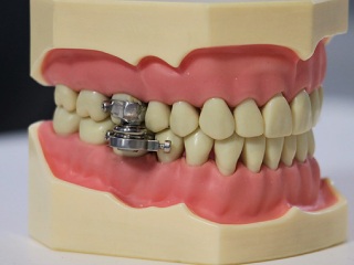 This Dental Device May Help Fight Obesity, But Twitter Users Find It Shocking