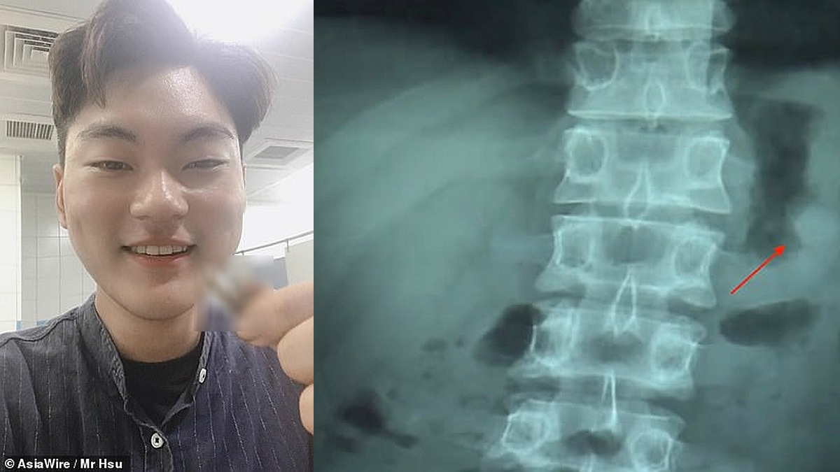 Apple AirPods Reportedly Survive Journey Through Human Digestive Tract After Man Accidentally Swallows One