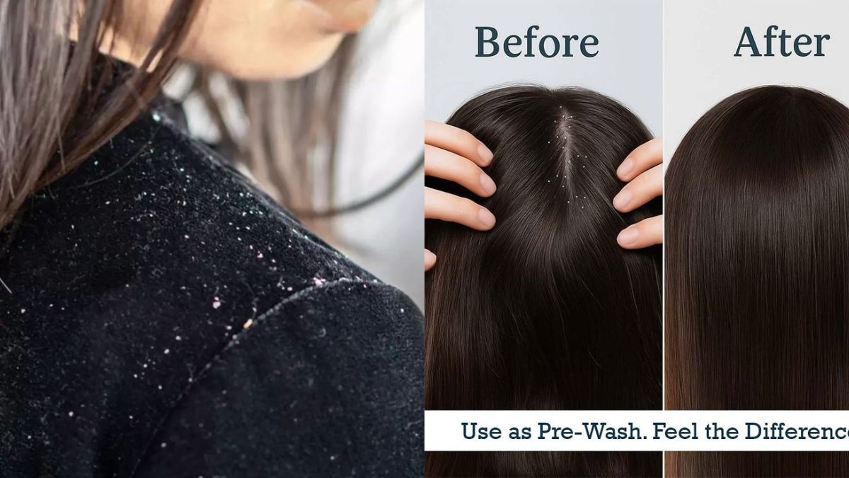 Best Anti-Dandruff Shampoos For Winters on Myntra: Explore Top Brands